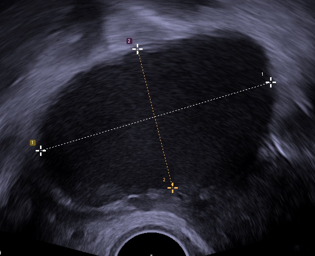 Endometrioma​